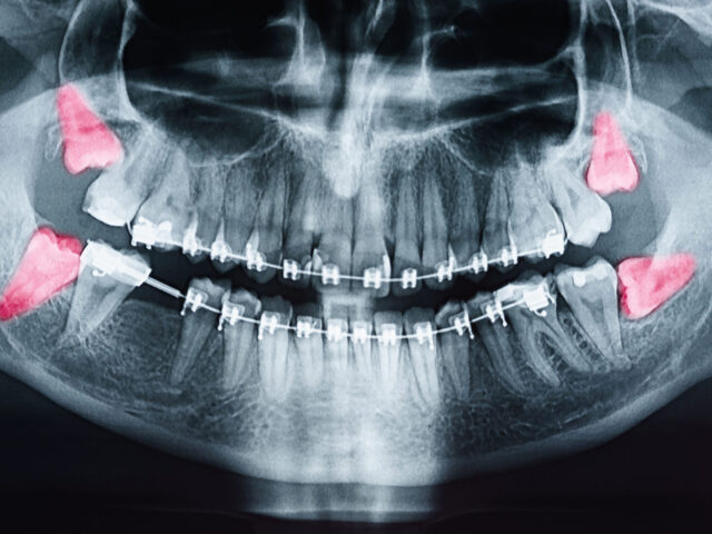 Dente del giudizio: tutto ciò che serve sapere