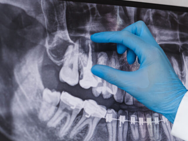 L’importanza della posizione dei denti